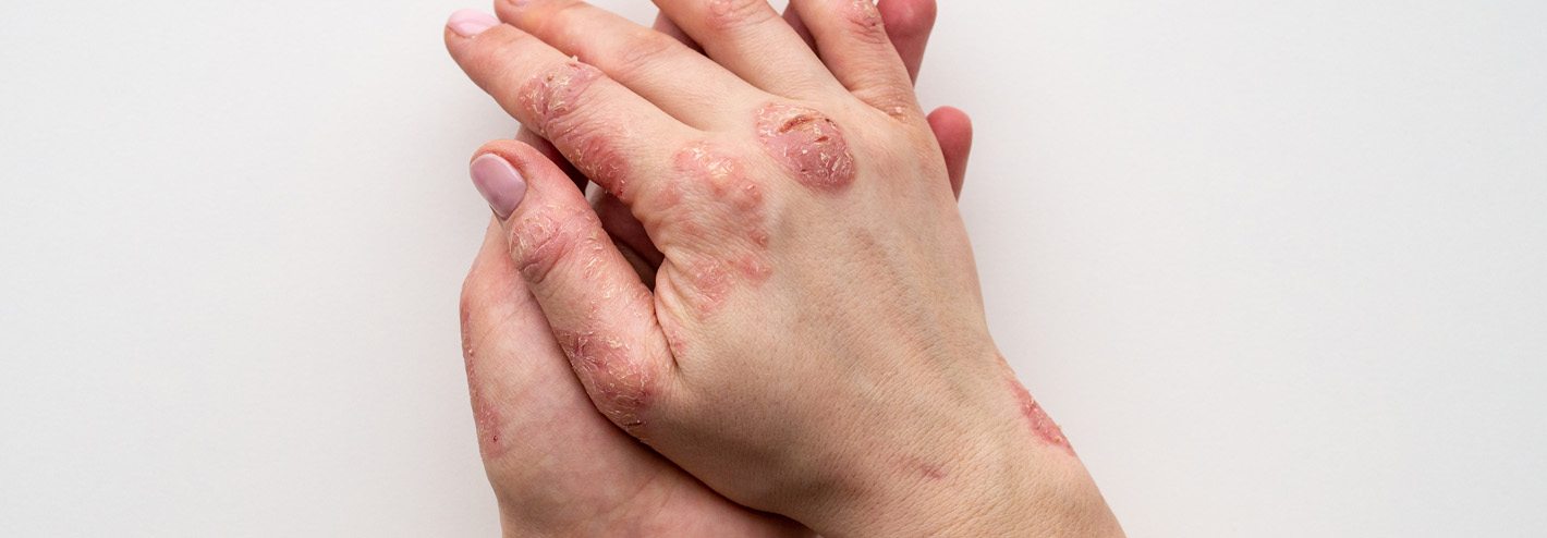 Hands with psoriasis on the knuckles